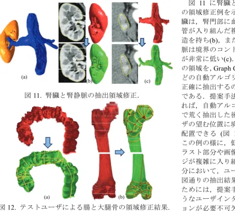 図 11 に腎臓と腎静脈 の領域修正例を示す．腎 臓は，腎門部に血管や尿 管が入り組んだ複雑な構 造を持ち(b)，また，腎静 脈は境界のコントラスト が非常に低い(c)．これら の領域を， Graph Cut 法な どの自動アルゴリズムで 正確に抽出するのは困難 である．提案手法を用い れば，自動アルゴリズム で荒く抽出した後，ユー ザの望む位置に境界面を 配置できる  (図 11(b)(c))． この例の様に，低コント ラスト部分や画像のエッ ジが複雑に入り組んだ部 分において，ユーザの意 図通りの抽出結