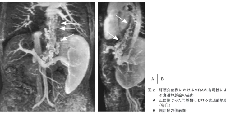 図 2 肝硬変症例におけるMRAの有用性によ る食道静脈瘤の描出 A 正面像でみた門脈相における食道静脈瘤 （矢印） B 同症例の側面像A      B