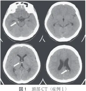 図 ₁  頭部 CT（症例 １ ） 腫瘤陰影と脳室内出血（矢印）を認める