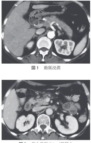 図 2  傍大動脈リンパ節腫大