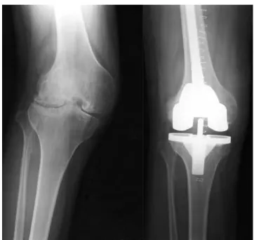 図 4　人工膝関節全置換術　当院で行った症例の術前（左）および術後（右）の X 線写真。