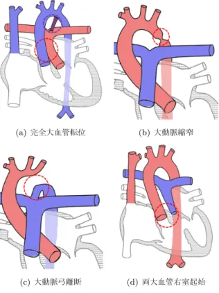 図 2 先天性心疾患の一例