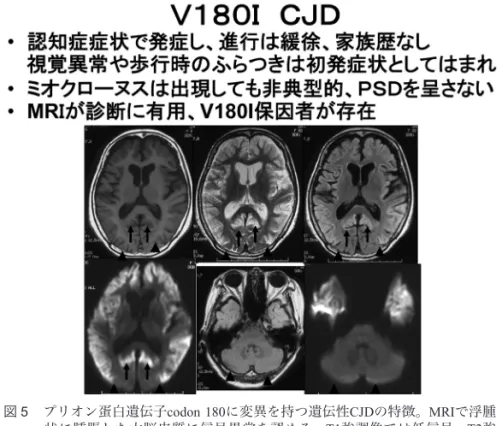 図 6  プリオン蛋白遺伝子codon 232に変異を持つ遺伝性CJDの特徴。緩徐に進行 し、脳波でもPSDが出現しない亜型が25%存在する。視床内側の高信号が この亜型の特徴である。 図 5  プリオン蛋白遺伝子codon 180に変異を持つ遺伝性CJDの特徴。MRIで浮腫状に腫脹した大脳皮質に信号異常を認める。T1強調像では低信号、T2強調像、FLAIR、拡散強調MRIでは高信号を呈する。視覚野を含む後頭葉は初期には異常信号を認めない。臨床症状に比較してMRIでの異常が顕著である。老年期認知症研究会誌 