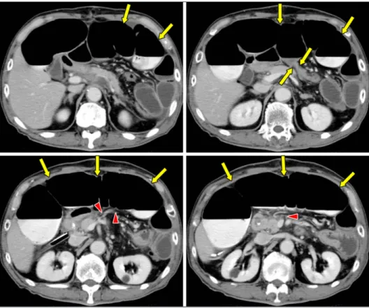 Fig. 3 Axial  image  of  abdominal  CT  scan  shows  stricture  of  the  transverse  colon  at  the  splenic flexure,  volvlus  and  dilatation  of  the  oral  side  transverse  colon  (arrows)