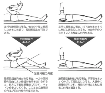 図 4 Thomas test （林典雄著：運動療法のための機能解剖学的触診技術 下肢・体幹より許可を得て転載）腸腰筋の拘縮を判別する手段  腸腰筋の拘縮は、腰痛や跛行の原因となり早期に判別し加療する必要がある。一般にはThomas  test（図左）がよく知られており、同時にその角度の判別も可能である。また、患者をベッド上に寝かした際、腰椎の前弯の程度をチェックする習慣をもっておくと屈曲拘縮の見落としが少なくなる（図右）。 正常な股関節の場合、他方の下肢は伸展したままの状態で、股関節屈曲が可能である。 股