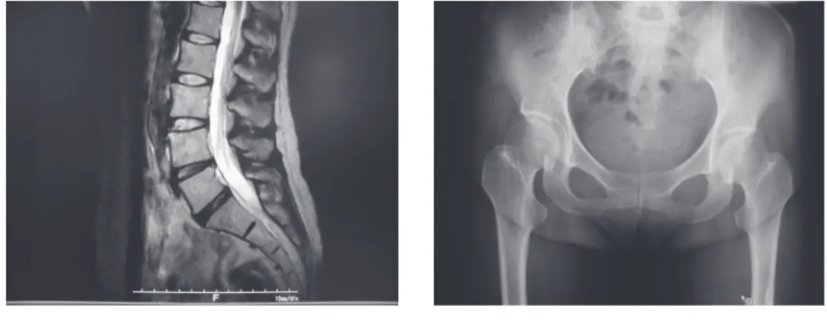 図 1　画像所見 腰部のヘルニアや脊柱管狭窄等の所見なし（左）