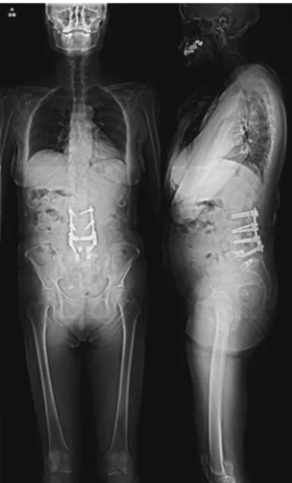 図 9 再手術後全脊椎像（図 7 と比べて膝関節や股関節は伸展し前 傾姿勢は改善を得た）  図 10 再手術後 6 カ月腰椎単純 X 線像（L2 椎弓根スクリュー周 囲に骨透亮像と骨硬化が見られたが，インプラントのバックア ウトやアライメント悪化はなかった） 増え骨折を助長した可能性があると考えた． 筋固縮，無動により自発的な行動が少なくなることで 骨質低下，筋力の低下がおき，骨折しやすくなると考え た．過去にパーキンソン病罹患女性で有意に骨粗鬆症の 頻度が高く，骨折の頻度も高かったことが報告されてい る 