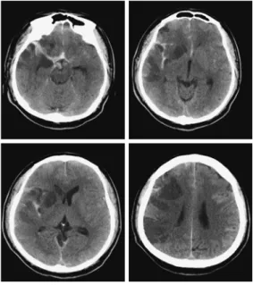 図 1 脳梗塞併発後の CT 画像 今回，くも膜下出血，脳梗塞後に左上肢・手指に重度 の運動麻痺と注意機能障害，記憶障害の後遺症が残存し た症例に対し，急性期より長期に渡り両立支援で関わる ことで，新規就労に至ることができた事例を報告する． 2．症 例 症例は 40 代男性，血豆状脳動脈瘤の破裂によるくも膜 下出血を発症し，当院にて側副血行路を考慮して右内頸 動脈閉塞術を施行．術後に右中大脳動脈領域広範囲に脳 梗塞を併発（図 1）し，左片麻痺や重度の意識障害を呈し ていた．発症後 9 日目にリハビリテーショ