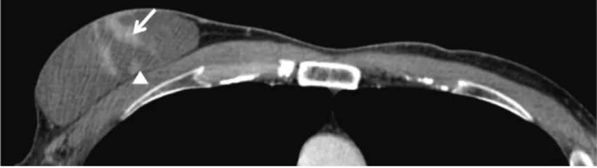 Fig. 4　割面写真：嚢胞壁の一部と乳頭状の充実部分（矢印）がみられる．