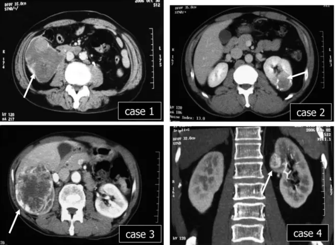 Fig. 1. Abdominal enhanced computed tomography of our four cases. CT showed an irregular enhanced large tumor