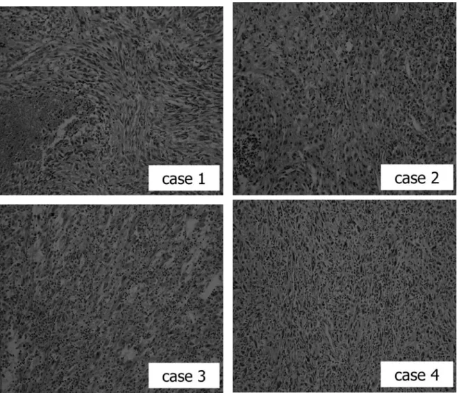 Fig. 2. Pathological ﬁndings in four cases of sarcomatoid renal cell carcinoma. Clear cell carcinoma was intermixed or embedded in high-grade sarcoma-like neoplastic ﬁeld.