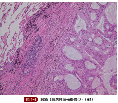 図 1-4 腺癌（腺房性増殖優位型）（HE)