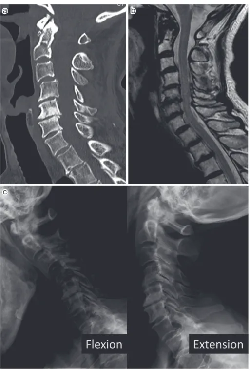図 2  （a）， （b） ：症例 2 の初診時 CT，MRI．C4/5， 5/6 で頸髄の圧迫あり．環軸椎関節周囲に T2 強調像で不均一な低信号域あり．後縦靭帯の骨化や骨折なし． （c） ：単純 X 線．多椎間で椎間板 腔の狭小化とすべりあり．環軸椎の亜脱臼なし． ExtensionFlexioncc が増強し，物がつかめなくなり整形外科診療所を受診し 頸髄症と診断．手術加療を勧められ当院を受診した． 既往歴・家族歴：高血圧，骨粗鬆症． 初診時現症：両上腕〜手指全体にかけて痺れあり．両 膝関節裂隙に圧痛