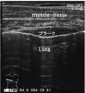 図 1 正常胸膜像（プローべを肋骨に水平にあてる場合）ਜ਼ ৙ ڵ ຜ 図 2 正常胸膜像（プローべを肋骨に垂直にあてる場合）ᶐᶇᶀᶐᶇᶀ 図 3 胸膜プラークの超音波所見ἩἻὊἁᵪᶓᶌᶅᾼᶓᶑᶁᶊᶃ ᶒᶇᶑᶑᶓᶃᴾ 図 4 75 歳 石綿曝露歴なし症例の CT 像 正常胸膜の超音波所見について 正常胸膜は胸筋群と肺の間に位置して高輝度のエコー を呈する．呼吸や心拍の影響をうけて lung pulse という 臓側胸膜の振動する所見が得られる．図 1 図 2 で正常 像を示す．図 2 の矢印部は胸膜である． 