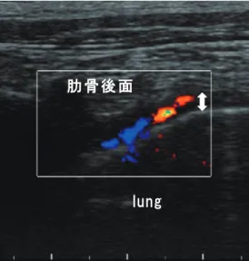図 5 75 歳 石綿曝露歴なし症例の超音波像ᶊᶓᶌᶅᎺᭌࢸ᩿ 図 6 78 歳石綿曝露歴あり症例の CT 像 図 7 78 歳石綿曝露歴あり症例の超音波像ἩἻὊἁᎺᭌࢸ᩿図 8 63 歳大工の胸部レントゲン 在を認めない． ③肋下筋についても脂肪組織と同様の内容で胸膜プ ラークと鑑別できると考える． ④肋間静脈であるが胸膜プラークの鑑別について時に 肋間静脈との鑑別が必要になることがある．肋間静脈は 肋骨溝の内側を走行しておりドップラーを使用すると超 音波検査で容易に描出できる．これに対して胸膜プラー ク