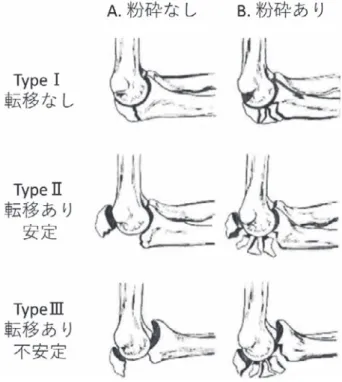 図 1 Mayo 分類（文献 2 より改変） 図 2 症例 1 初回手術 X 線 a：初診時，b：術直後，c：術後 19 日acb 症 例 3 82 歳，女性．路上で転倒し左肘をついて受傷した．初 診時 X 線で，症例 1 と同様に Mayo 分類 type IIIA と診 断 し（図 6a），受 傷 後 12 日 に プ レ ー ト（Stryker 社