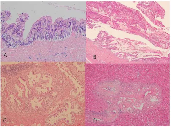 図 4 職業性胆管癌症例における主腫瘍以外の胆管の病理学的所見 A，Biliary intraepithelial neoplasia．B，Intraductal papillary neoplasm of the bile duct．C，胆管および 付属腺の腫瘍性増殖．D，胆管の硬化像と上皮傷害 暴露歴を有するのが 7 例であった．全例で γ-GTP が高値 で，CA19-9 値は 6 例で高値であった．主腫瘍による胆道 閉塞のため肝内胆管が拡張している症例を除く 4 例中 2 例において，主腫瘍による胆