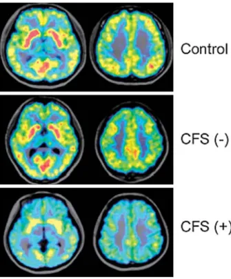 Fig. 1 Differences in mAChR expression on PET images in pa- Fig. 1 Differences in mAChR expression on PET images in pa-tients  with  chronic  fatigue  syndrome  (CFS)  with  or  without  mAChR  autoantibody 9) .  mAChR  expression  in  CFS  patients  witho