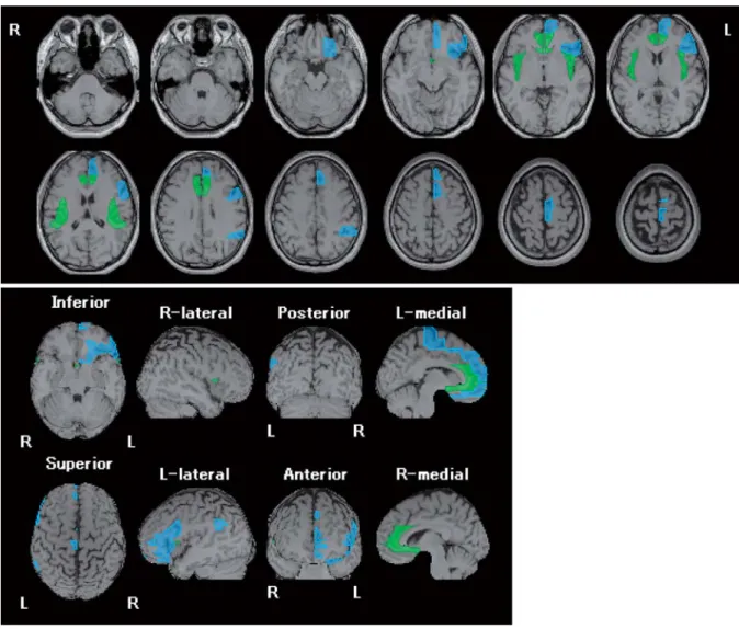 Fig. 2 Regions with decreased CBF in patients with depression. The greatest decrease in CBF occurred in the ACC, based on  voxel  based  stereotactic  extraction  estimation  (vbSEE)  analysis.  Upper  panel:  horizontal  section;  lower  panel:  brain  su