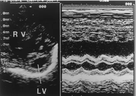 Fig. 3. The left ventricular internal dimension at end-diastole of patient 3 was 14 mm before open mitral valvotomy, and the left ventricular-right ventricular cross-sectional area ratio was 0.59