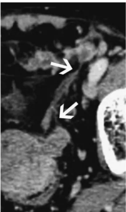 図 5 腹部造影 CT 横断（左骨盤内拡大図） 左にのみ精索と当該腫瘤を結ぶように太い索条物を認めた．その 索条物の両端に細い線状陰影を認め，それぞれ精索と，当該腫瘤 につながっていた（→）．精管と思われた． 図 6 腹部造影 CT 矢状断面 当該腫瘤（→）は，小骨盤腔を超え，最大径約 10cm であった． 図 7 腹部 FDG-PET/CT 横断面 当該腫瘤（▲）には，きわめて強い FDG 集積を認めた．CT で肥大が確認された左精索（→）にも高度の 集積を認めた．他，サイズは様々であるが，腹腔内に多数の