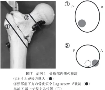 図 7 症例 1 骨折部内側の検討 ①ネイルが後方刺入（●） ②頸部前下方の骨皮質を Lag screw で破綻（●） 単純 X 線上で見える位置（○） た．症例 2 では，初回手術後の側面像での整復位が，生 田分類 ９） の Subtype P となっており，術後に過度の  tele-scoping を生じていた．症例 1，2 の共通点として，術前 骨折部の不安定性が強い症例であったことと，術後単純 X 線で固定性が不十分な所見を認めたことが挙げられ る．骨癒合獲得までに，骨折部の固定性が不十分である た