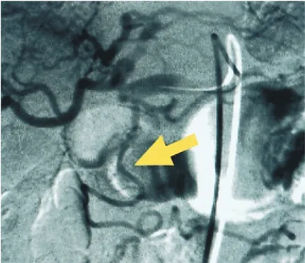 Fig. 4. Abdominal angiography