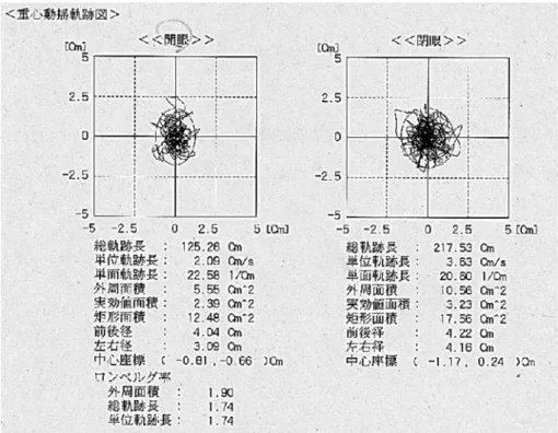 図 5 重心動揺計（PGT）XY 記録；両脚起立開眼 1 分間閉眼 1 分間 図 6 重心動揺記録分析；レーダチャート 図 16 に意識消失の期間の程度の総数に脳挫傷，側頭骨 骨折の占める比率を求めた．意識消失の程度と脳挫傷例 の比率，側頭骨骨折例の比率より相関係数を求めた． その結果は図 16 で表した．相関係数は脳挫傷；0.99 側頭骨骨折；0.94 で高い相関がある．脳挫傷例のほうが 高い． 2）脳挫傷範囲 GOBCA の程度と平衡機能検査異常成 績例の比率の検討． 図 17 に脳挫傷範囲の程度の総数