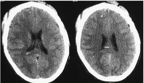 図 1 CT スキャン 受傷直後 図 2 MRI 拡散強調画像 受傷直後 2 級 随時介護 3 級 労務不可 5 級 1! 4 程度の労務能力 7 級 1! 2 程度の労務能力 9 級 3! 4 程度の労務能力 12 級 労務可・局所の頑固な神経症状 14 級 労務可・局所の神経症状 3．高次脳機能障害とは 高次脳機能障害は軽度性格変化から高度認知障害まで 様々である．その要素は，記憶・失語・失行・失認・注 意・遂行・情動・無視等の障害である．その程度は軽度 性格変化から高度認知障害まで様々で，概ね受傷時の