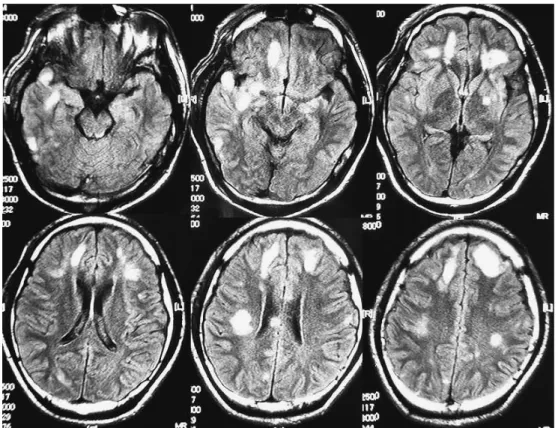 図 3 MRI FLAIR 画像 受傷直後 図 4 MRI FLAIR 画像 慢性期・脳挫傷・脳萎縮 要求されることが多い．それらの例は当初，非該当ある いは 9，12 級であった場合も多い．この乖離をどうする のかを問われることが多くなってきた．労災認定も自賠 責認定も，双方の基準に大きな隔たりは無いが，どちら かが先に認定されている場合の認定作業もあり，整合性 が問われる場合がある．同様に介護認定も実際の労災・ 自賠責認定の場で提出されることも多くなってきた．要 支援から要介護 5 までの等級が先に認定