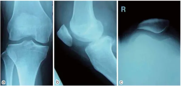 図 1 単純 X 線像ab c 図 2 MRI 像 a）T1 強調像 b）T2 強調像ab 発する １） ２） ．本疾患は滑膜の内膜下に存在する間葉系細胞 が軟骨化生して発症する良性腫瘍である．罹患関節とし て最も多いのは膝関節で，その他股関節・肩関節などの 関節に発症しやすい．本疾患は 1977 年に Milgram らに より遊離体と滑膜病変の関係によって 1〜3 期に分類さ れた ３） ．第 1 期は滑膜内に病変が限局し，遊離体のないも の，第 2 期は滑膜内病変と関節内遊離体が混在するもの， 第 3