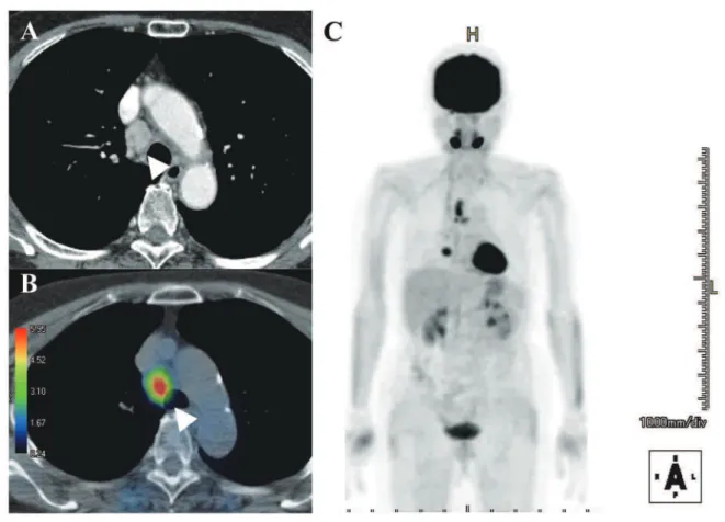 Table 4. Comparison of N staging with PET/CT scan and CT scan