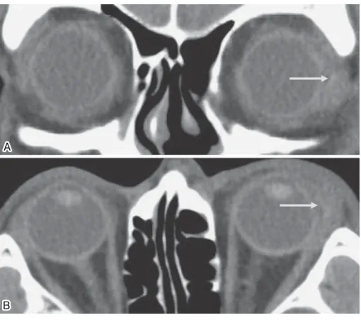 図 3 眼窩 CT 検査（A 冠状断，B 矢状断） 左外直筋付着部周囲の眼窩に血腫と思われる陰影を認める（矢印）．B 図 4 術中確認された木片 腱付着部から 8mm の筋腹に刺さっていた木片（矢印）． 図 5 摘出された木片 長さ 5mm×太さ 2mm の木の枝様の木片であった． 上転，外転制限は消失し，内転制限も右方視 30 度で 3 度と改善した（図 6）． 3．考 按 本症例は，術前の眼窩 CT 検査で血腫と誤認した木片 異物が原因で，眼球運動障害が生じていた．木片は外転 時に眼窩外側縁に引っかかり