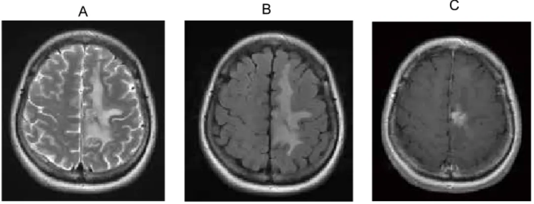 Figure 2. 　Brain MRI at initial presentation showed a left cingulate tumor surrounded  by widespread edema on T2-weighted imaging (A), diffusion-weighted imaging (B), and  gadolinium-enhanced T1-weighted imaging (C).
