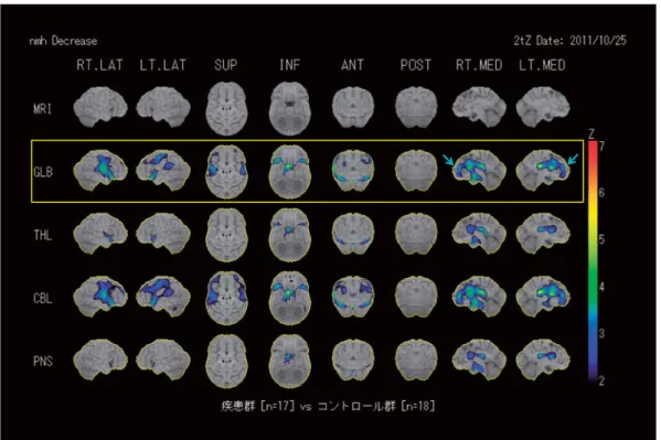 図 1 健常群と疾患群 17 例の 123 I-IMZ SPECT 3D-SSP 画像の群間比較（Z-score＞2） 最上段：標準脳を 8 方向からみたもの．左から右外側面・左外側面・上面・下面・前面・後面・右内側面・左内側 面を示す 2 段目：全脳（GLB）により正規化された 3D-SSP 解析画像（群間比較） 3 段目：視床（THL）により正規化された 3D-SSP 解析画像（群間比較） 4 段目：小脳（CBL）により正規化された 3D-SSP 解析画像（群間比較） 5 段目：脳幹・橋（PNS）により