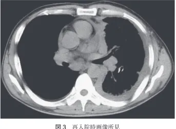 図 3 再入院時画像所見 著明に肥厚した胸膜が肺を取り囲む環状胸膜肥厚を認めた． 図 4 剖検所見 （A）著明に肥厚した胸膜は左肺全体を覆う様に取り囲んでいた． （B）左肺中心部に正常肺の残存を認めていたが，肺末梢には著明な腫瘍の進展や浸潤像を認めた．明らか な腫瘤性病変は認めなかった．A B表 2 胸水穿刺所見PropertyBloody，turbidSpecific gravity1.036Rivalta（−）Runeberg（＋）Total protein4.8g/dlErythrocyte100/H