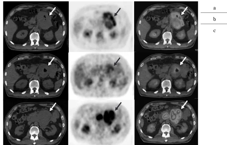Fig. 3. Transaxial CT (left), FDG - PET (middle), and fusion (right) images of the abdomen in a 50 - year - old man with GIST cate- cate-gorized as high risk