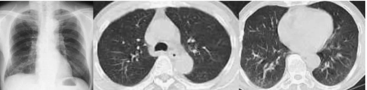 図 3  第 22病日胸部 X線写真・胸部 CT 所見を認めず人工呼吸器関連肺炎と診断し，Ceftriaxone 1g ! day 点滴を開始した．全身に紅斑がみられたので，第 8 病日より Biapenem 0.6g! day に変更した．その後炎症 反応は改善し，浸潤影は消失，紅斑も消失した．第 9 病 日酸素化が改善したため抜管し，第 11 病日状態が安定し たため一般病棟に転棟した．第 19 病日自覚症状が改善し 画像所見も改善したため軽快退院した（図 3）．WBC， CRP はすぐに軽快した．LD