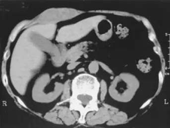 Fig. 4. Ultrasound shows a marked decrease in the mass, and the echo density is almost homogenously low