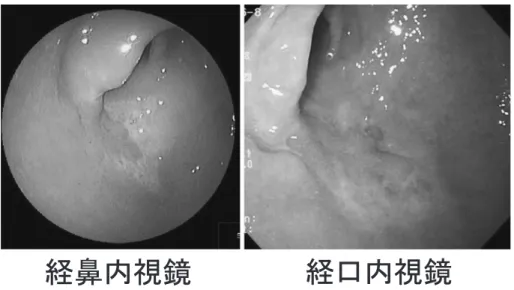 図 9 早期胃がんの内視鏡像の対比