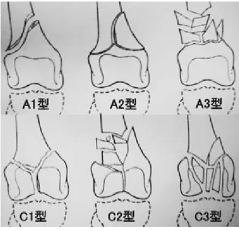図 1 骨折の評価（AO分類） 表 1 骨折の評価（AO分類） 合計AO-C型AO-A型  95 4DCS群 102 8RIN群 19712合計 Fi s herの直接確率 P値＝ 0