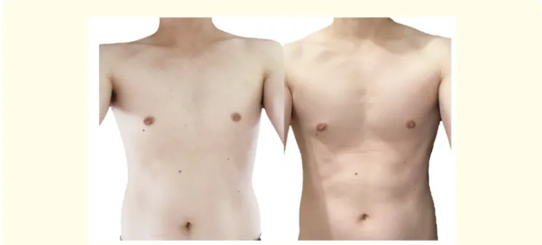 Figure 1: Changes in chest muscles before and after the home self-training on push up.