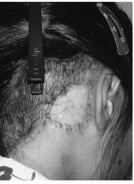 図 3 表皮母斑切除後全層植皮
