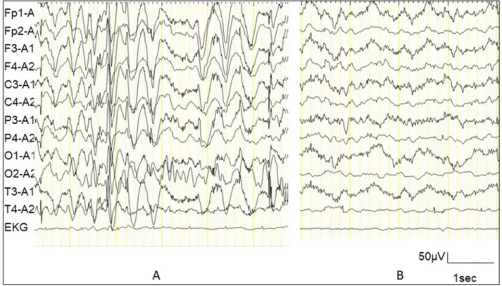 Figure 3. EEG findings. A. EEG during an episode of eating difficulty. Diffuse 2-3 Hz high voltage slow  waves mixed with spike-waves appeared continuously, which was different from his usual awaking record