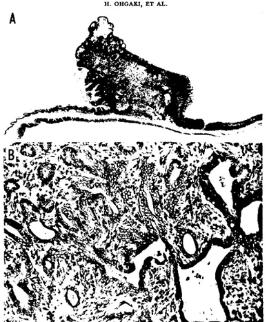 Fig.  2.  Gastric  adenocarcinoma  observed  in  the  fundic  region  contiguous  with  the  limiting  ridge  in  a  rat 