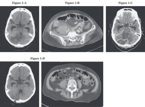Figure 1. 1-A: Prain brain CT scan reveals low density area on right cerebellum and hydrocephalus due to pressure of ventriculus quartus