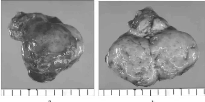 Fig. 7 : Pathological examination revealed a dedifferentiated tu- tu-mor (HE).