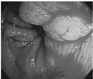 Fig. 1：Endoscopic study showed the rectal tumor.