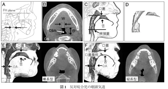 図 1 反対咬合児の咽頭気道 A：中咽頭気道（OA）の計測部位． B：中咽頭気道断面；CSA 断面積，W 幅径，D 長径． C：矢状断面． D： 左 咽頭気道，右 口腔内気道． E：低位舌を認める反対咬合児；左 低位舌を認める，右 横長型の中咽頭気道． F： 口蓋扁桃肥大に伴う反対咬合児；左 口蓋扁桃肥大に伴う舌の前方位，右 縦長型の中咽頭気道（文献 2 を一部改編）． 図 2 上気道流体シミュレーションによる気道通気状態の評価 A：構築する上気道 3 次元モデルの部位．B：上気道 3 次元モデルを用いた呼