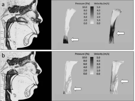 Figure 2. Example of change in ventilation of the PA using computational fluid dynamics (CFD) in a Herbst treatment patient (a) before Herbst treatment